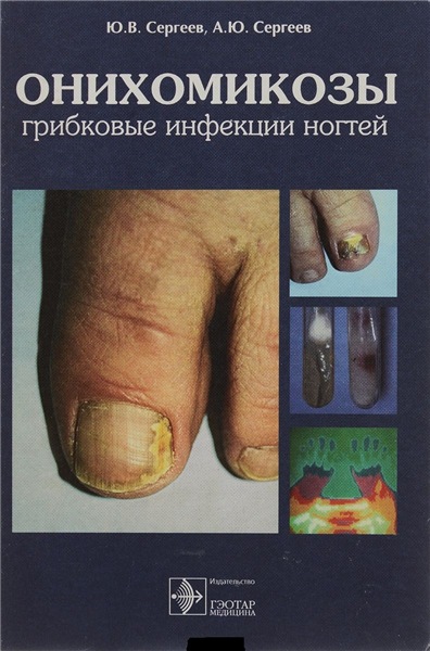 А.Ю. Сергеев. Онихомикозы. Грибковые инфекции ногтей